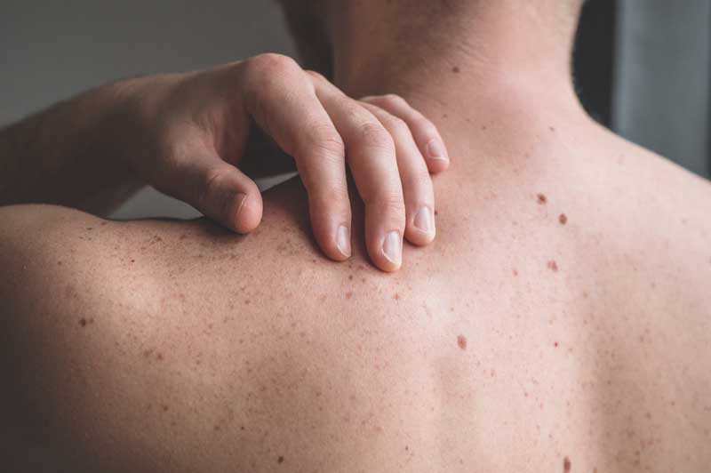 Checking benign moles. Close up detail of the bare skin on a man back with scattered moles and freckles