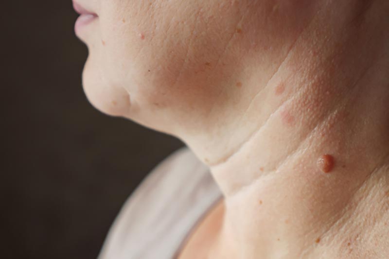 A young woman with excess fat on her upper arm with marks for liposuction or plastic surgery